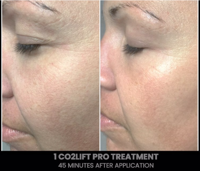 CO2Lift Carboxy Gel Therapy Treatment